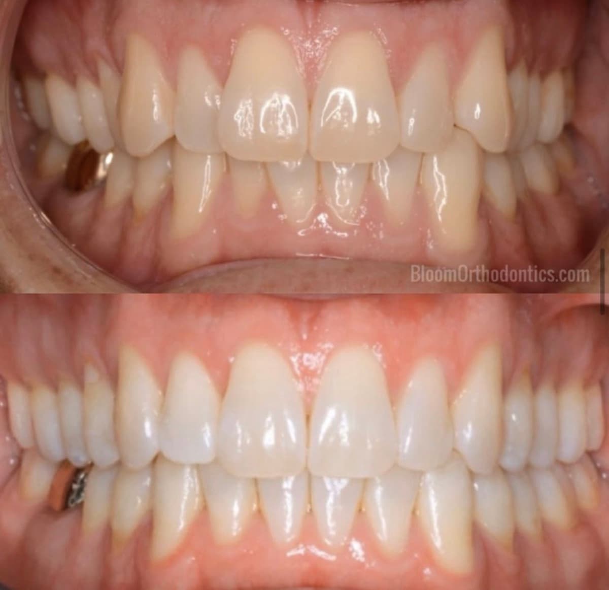 Spacing & Gap Closure — before and after