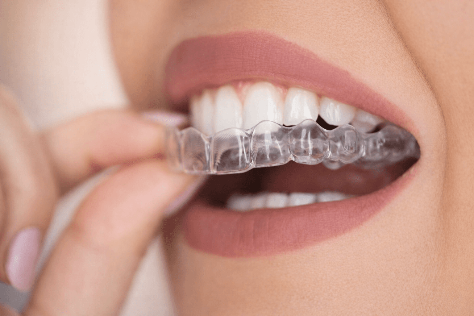 Clear Aligners